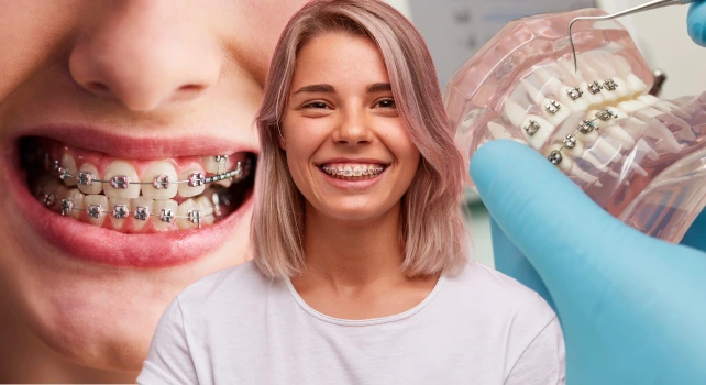 Pessoas sorrindo com aparelho ortodôntico.