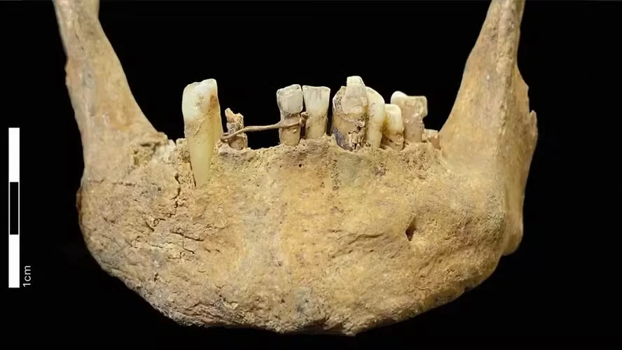 Fio de ouro 20 quilates utilizado como ponte dentária na Escócia durante a Idade Média. 