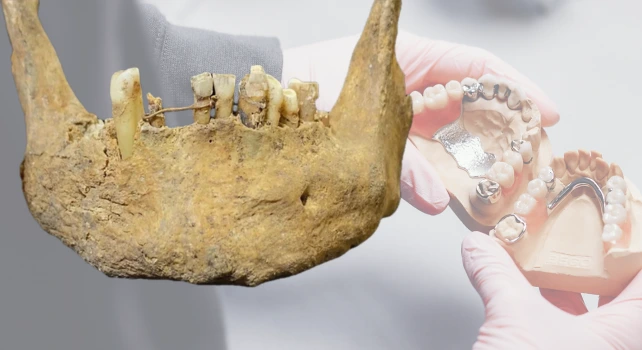 Ponte dentária de 500 anos em comparação com a odontologia moderna.