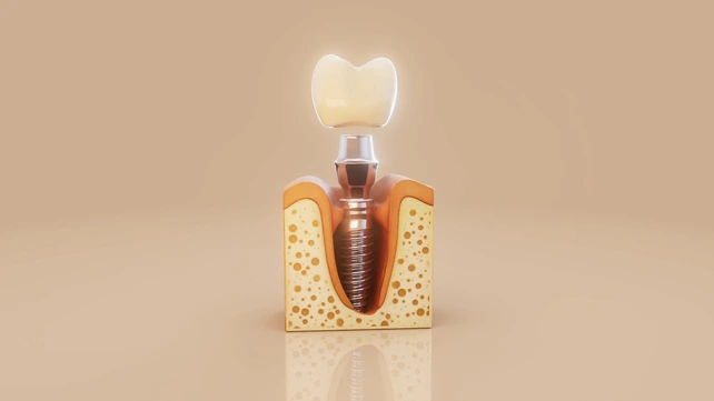 Ilustração de um implante dentário unitário.
